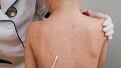 الصين تكشف عن سلالة متحورة جديدة من جدري القردة