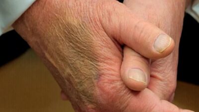 كدمة زرقاء على يد ترامب… والبيت الأبيض يكشف السبب