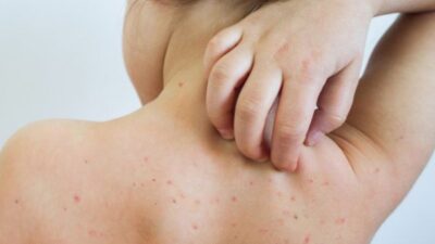 تراجع الإصابات بالحصبة في أوروبا وآسيا الوسطى 75% خلال 2025